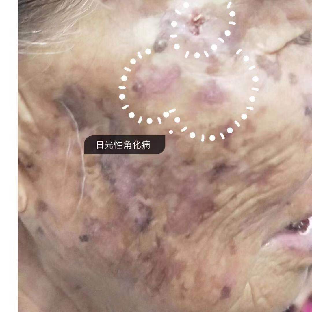 85岁娭毑的皮肤问题——都是不防晒的错