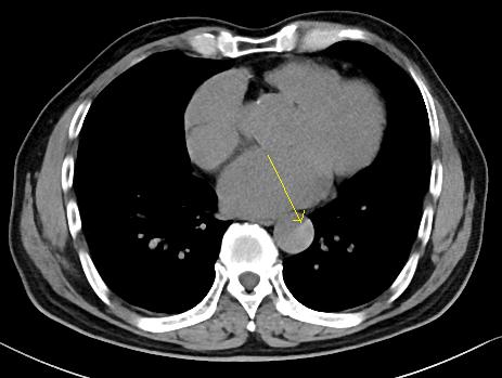 胸部Ct平扫能查出主动脉夹层吗,主动脉夹层cta影像图片解读