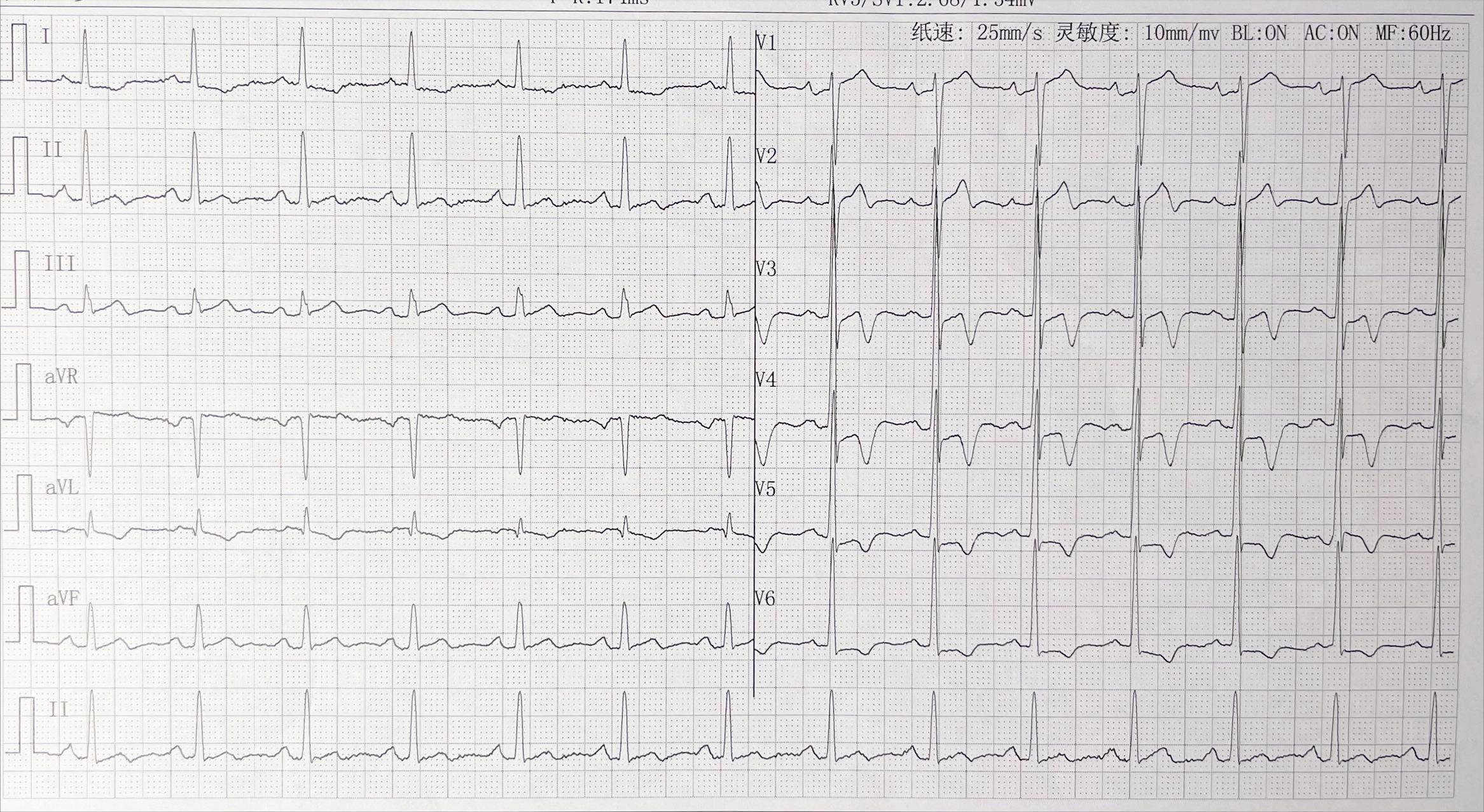 中年男士胸闷做什么ct,胸闷胸痛查冠脉造影