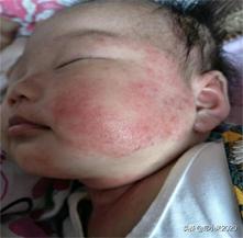 宝宝湿疹红屁股该怎么办,没出满月的宝宝湿疹还有红屁股