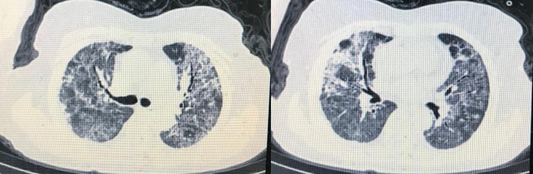 HFNC可能比无创通气更适合用于COVID-19导致的低氧血症？