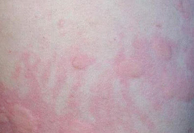 麻疹有哪些症状荨麻疹是啥样的,麻疹和荨麻疹的区别在哪里