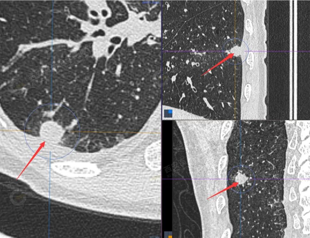 petct检查报告肺结节考虑恶性肿瘤,30mm肺结节pet显示没有转移