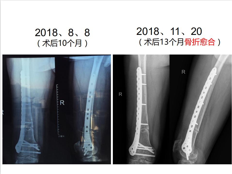 平乐骨科推拿教学,中医治疗骨折畸形愈合