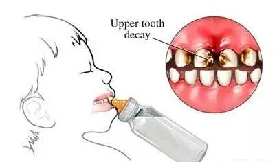 奶瓶龋对婴幼儿牙齿损害有多大,奶瓶龋主要发生在哪颗牙齿