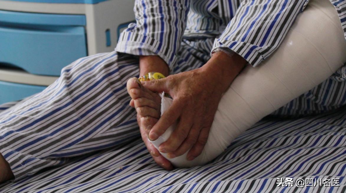 静脉曲张的致残率,静脉曲张最终会是什么结局