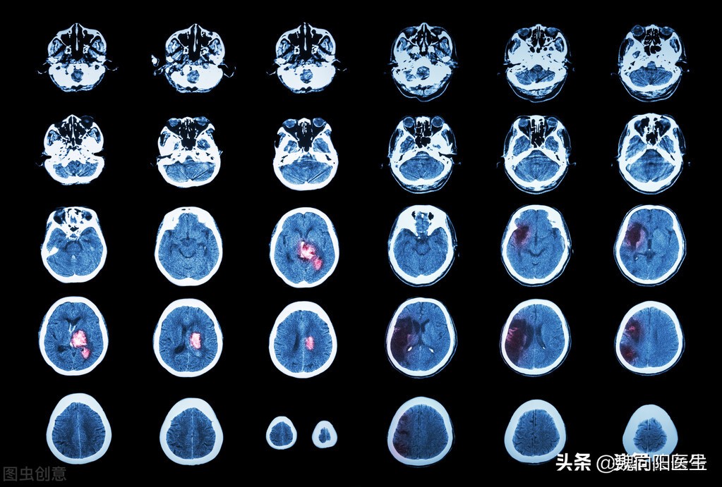 老人血管狭窄能活多久,头血管狭窄严重是否可以保守治疗