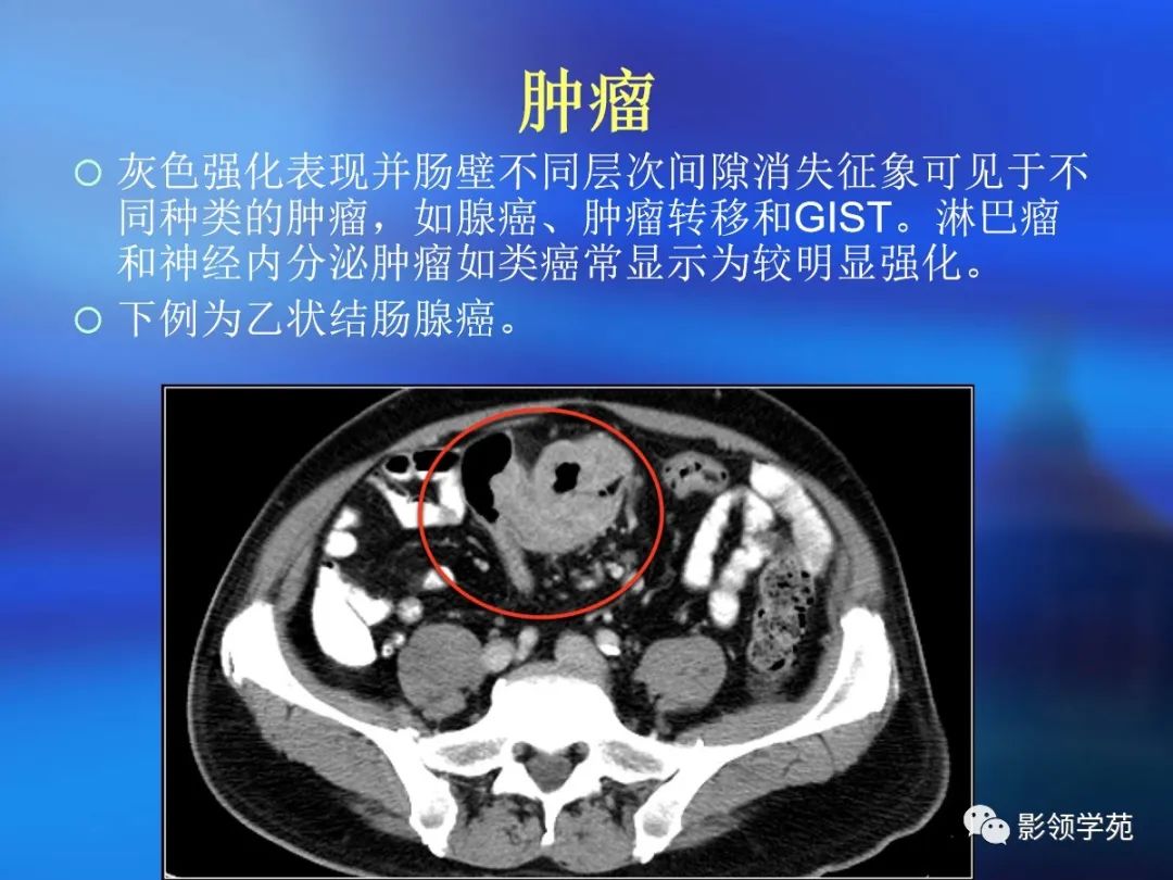 肠道内壁增厚,肠道扩张ct表现
