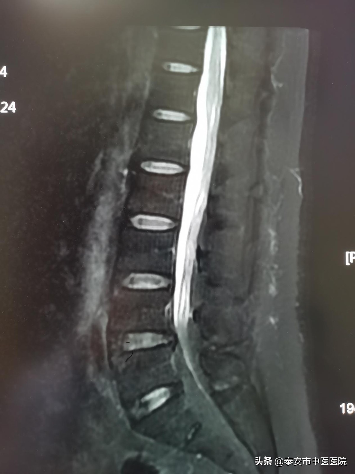 *安泰**市中医医院脊柱外科成功治愈罕见“椎管内脂肪增多症”