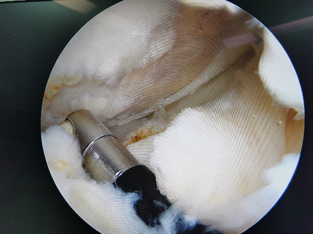 膝关节阶梯治疗ppt,膝关节骨性关节炎阶梯化治疗