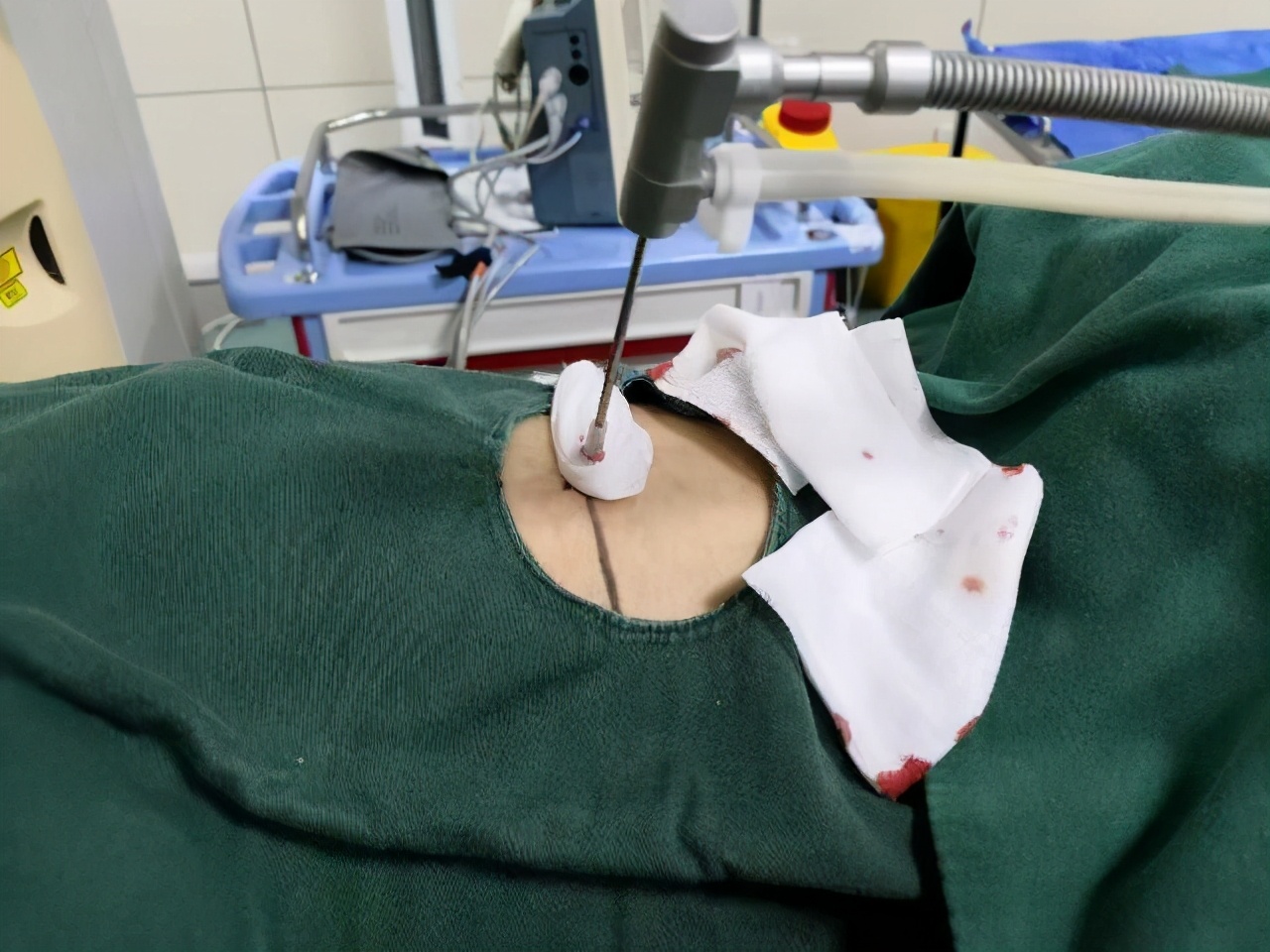 肺部肿瘤的热消融技术,消融术治疗肺部恶性肿瘤