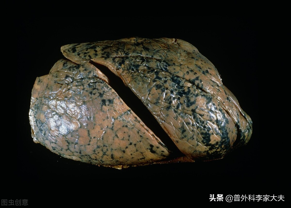 肺腺癌出现声音嘶哑能治好吗?