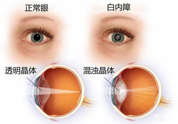 白内障到底是什么！你了解白内障吗？