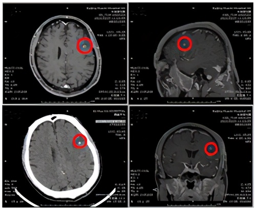 迷雾追踪迅驰,脑囊虫为什么会潜伏几十年