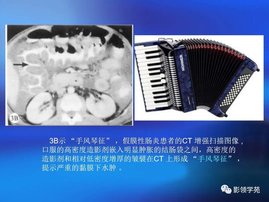 肠道内壁增厚,肠道扩张ct表现