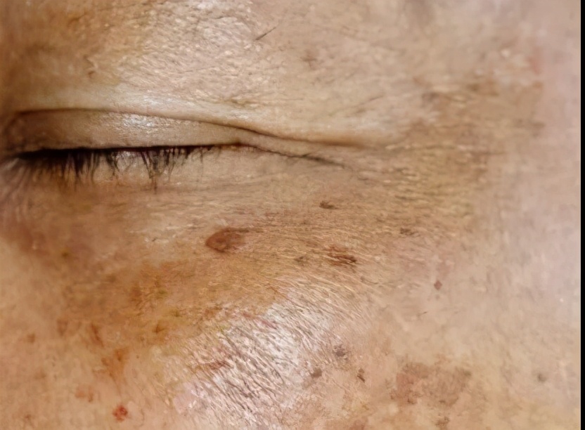 祛除老年斑最简单的方法,祛除老年斑最有效方法