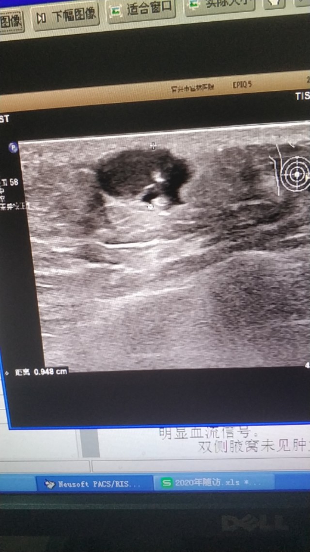 皮脂囊肿简介,皮脂囊肿和脂肪囊肿的区别