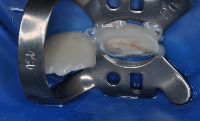 牙拔掉后扔掉还是留着,牙折断还能接回去吗