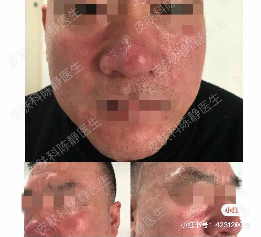 鼻头发红是日光性皮炎还是酒渣鼻,鼻头隐约有点红