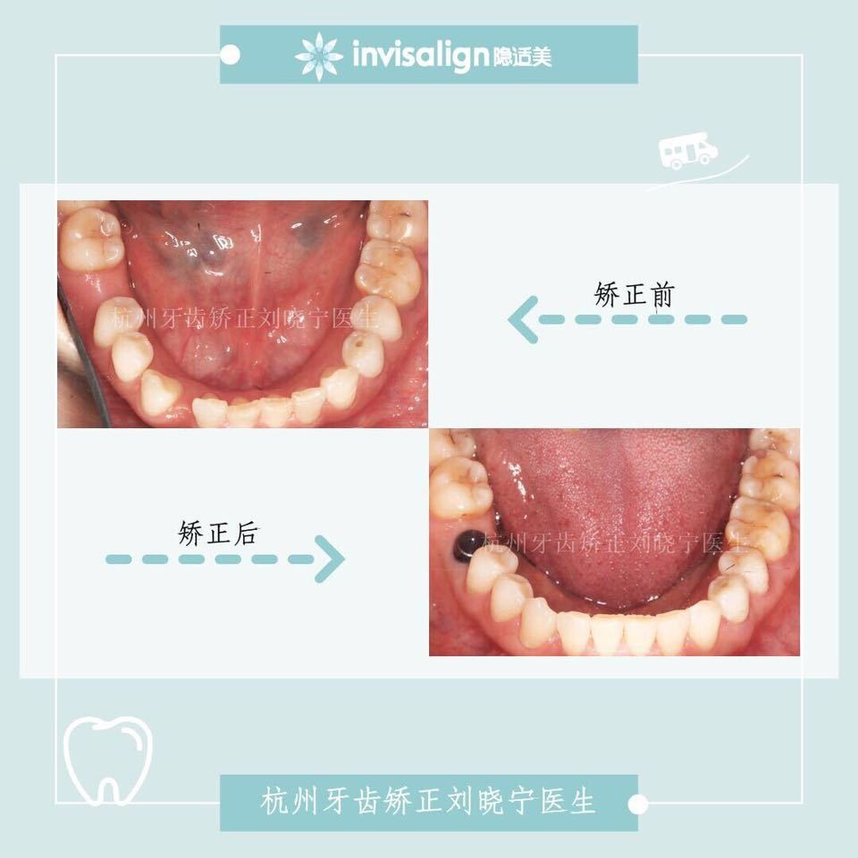 杭州牙齿深覆合矫正,杭州牙齿矫正有什么方法