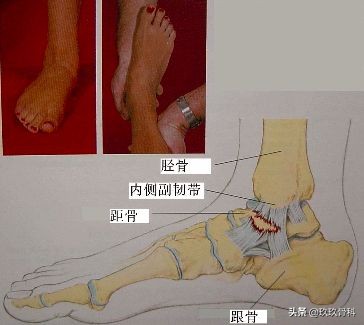 陈旧性踝关节损伤的治疗,踝关节损伤现场处理视频