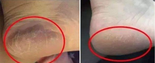 冬天脚后跟干裂用什么润脚霜,润足脚后跟干裂修复霜