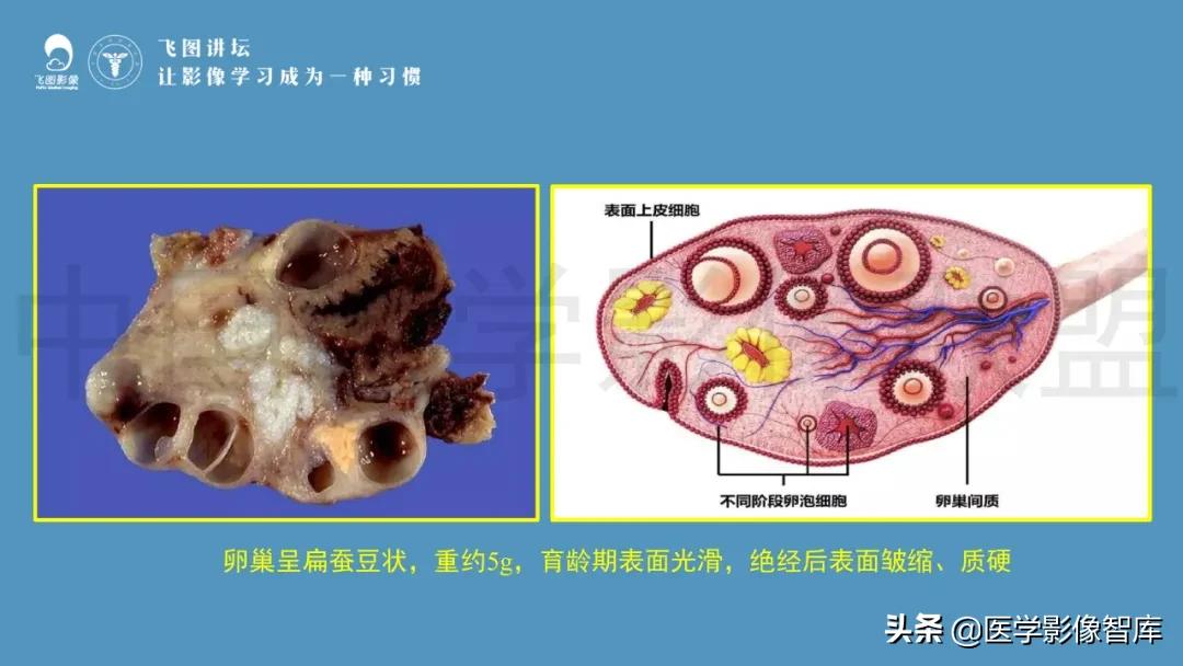 子宫解剖结构输卵管和卵巢位置,子宫附件ct影像学正常解剖表现