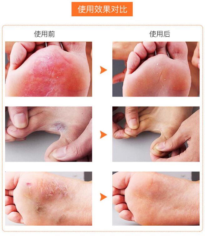 脚气特别痒用什么泡脚效果好,脚气脚臭脚痒的克星用什么