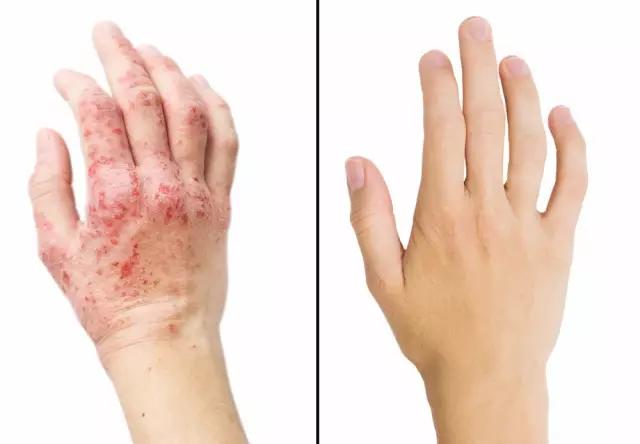 糖皮质激素药膏有多可怕,关于糖皮质激素类药物说法错误的