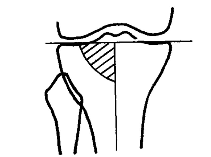 膝关节x线片可以查出啥,膝关节间隙x线测量方法