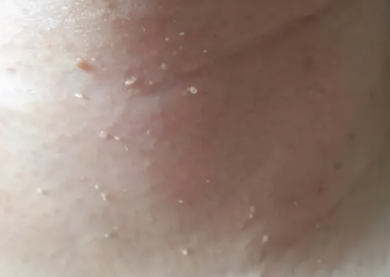 脖子腋下腹股沟长小肉粒怎么去除,腋下脖子上长小肉粒是什么原因