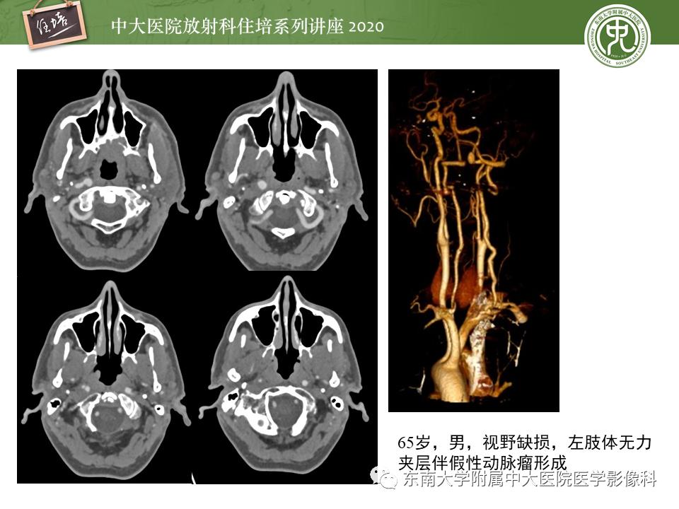 颈动脉夹层的超声表现及漏诊分析,动脉夹层与夹层动脉瘤是一样的吗