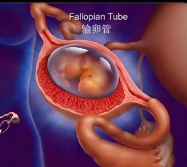 早期诊断输卵管妊娠最准确的方法,孕早期如何治疗妇科炎症