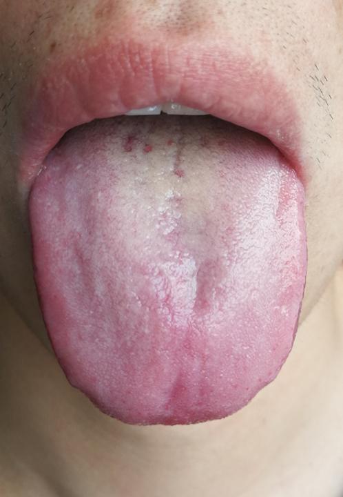 类风湿性关节炎是受凉引起的吗,类风湿关节炎可诱发什么病