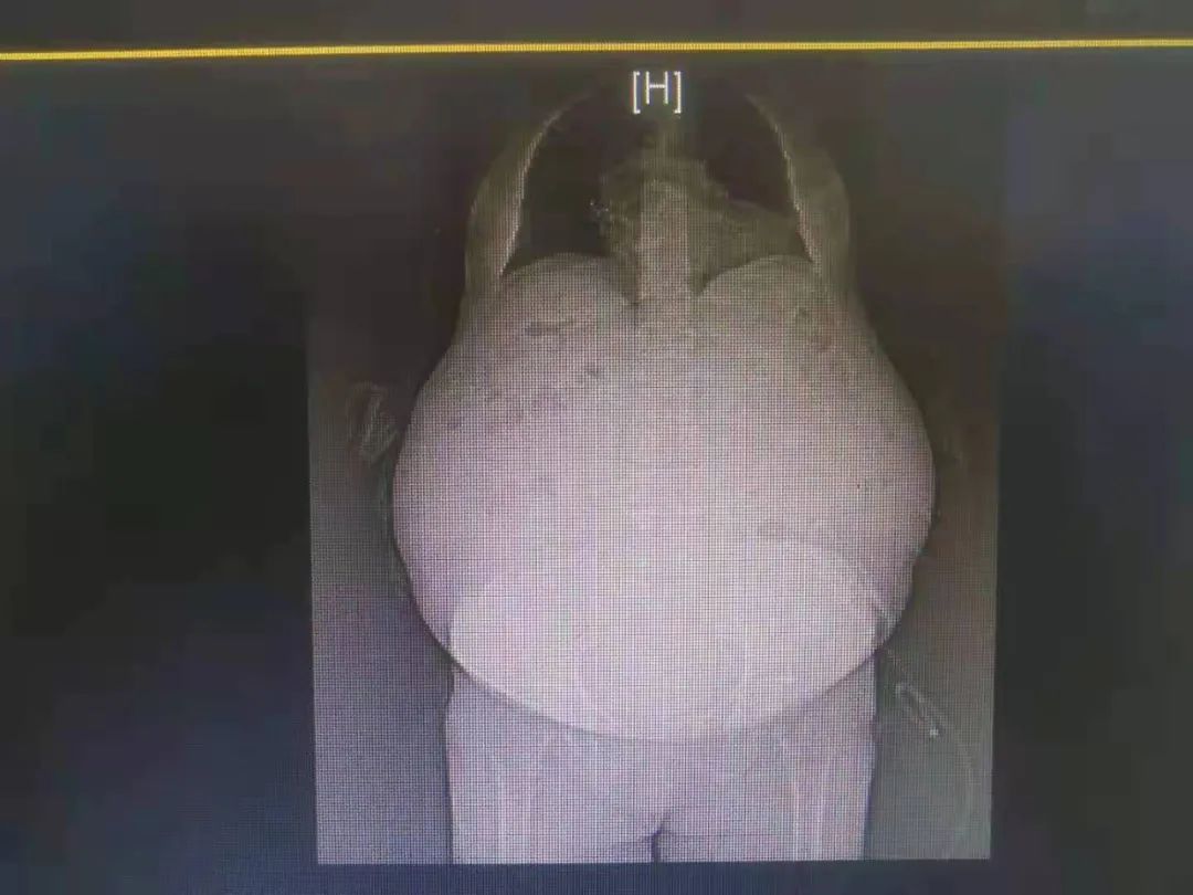 91岁老奶奶腹中35斤巨大肿瘤在株洲市中心医院妇科成功摘除