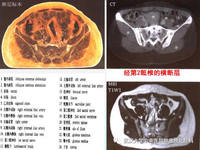 女性盆腔解剖与断层影像