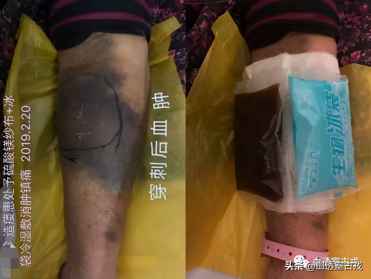 内瘘血肿,穿刺后皮下血肿怎么处理