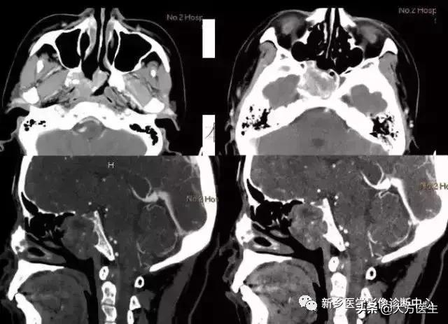 钙化灶是良性肿瘤的可能性大吗,颅内肿瘤钙化发生率最高