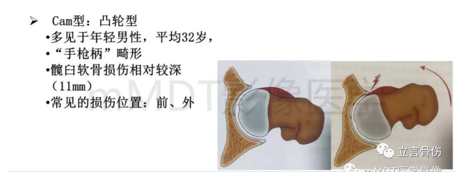 股骨髋臼撞击综合征吃哪些药呢,股骨髋臼撞击综合征做手术多少钱