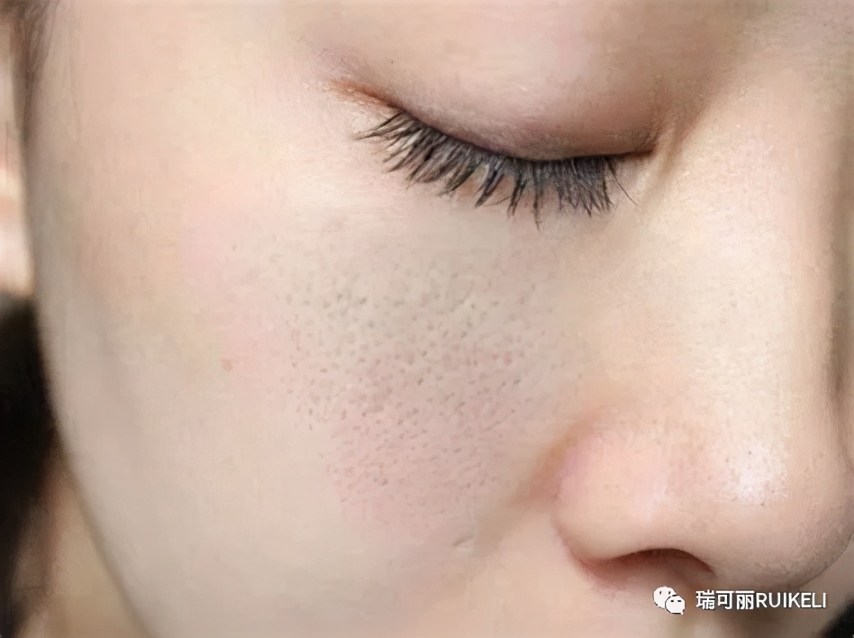 怎样让粗大的毛孔减少,毛孔变黑且粗大怎么治