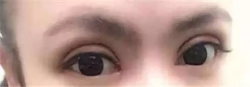 双眼皮整形修复,潘贰双眼皮修复