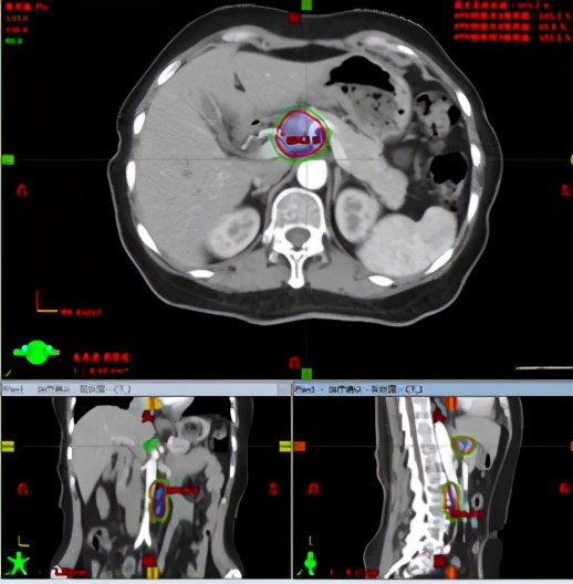 sbrt肿瘤放疗副作用有哪些,复发宫颈癌常用化疗方案