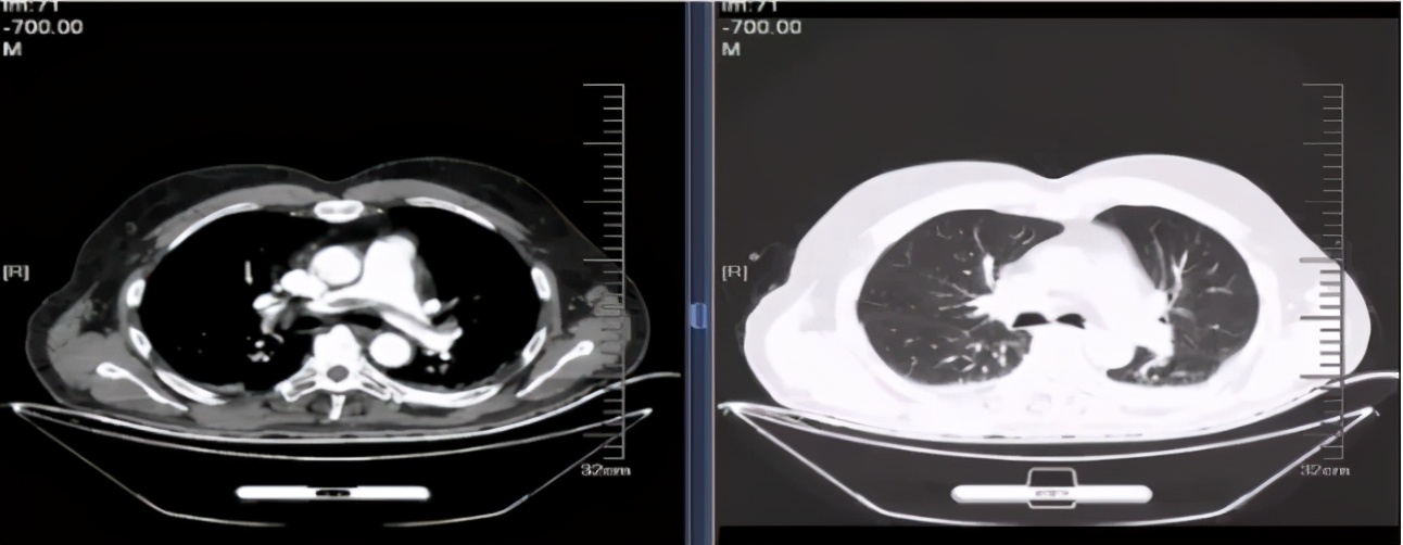 华润健康乡村|郑锐教授：从指南到临床看肺栓塞抗凝治疗