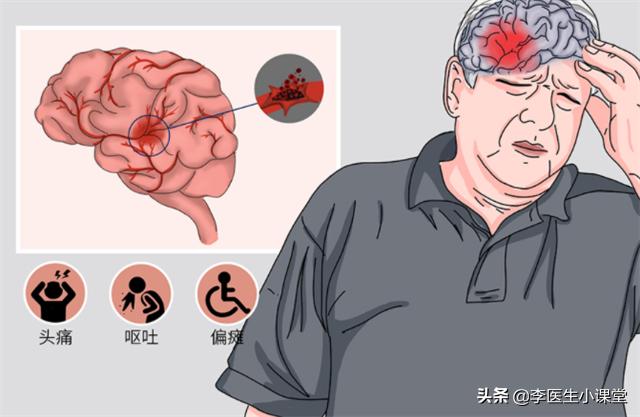 高血压引起脑出血急救方法,高血压脑出血晕倒一小时急救