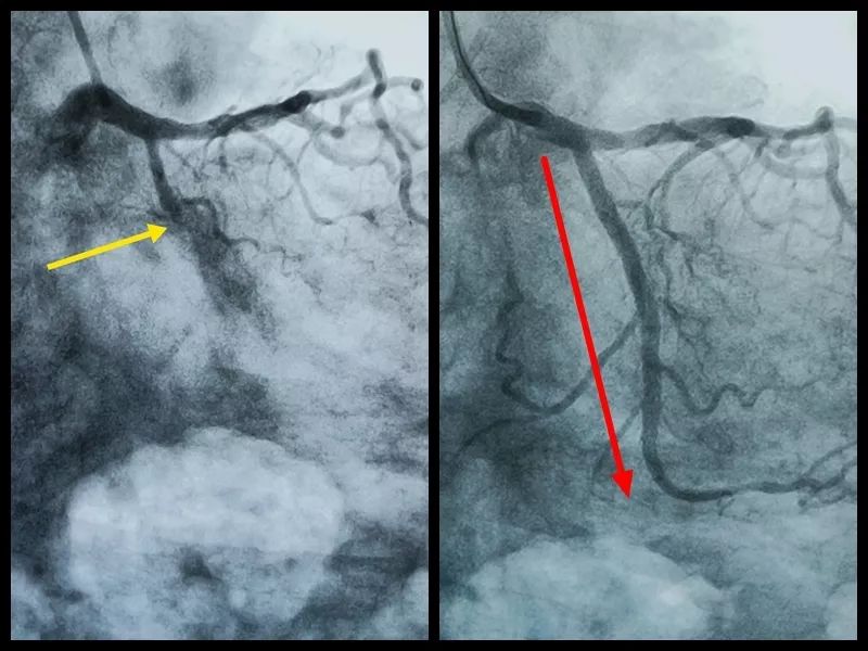 心血管严重堵塞不能放支架怎么办,心血管完全闭塞支架失败