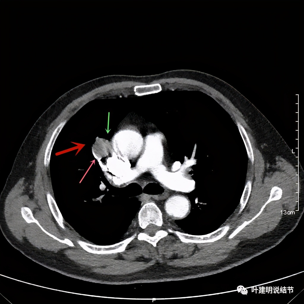 误诊报告图片,误诊案例及案例分析