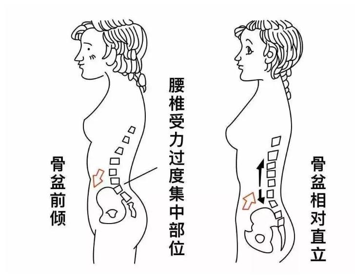 骨盆前倾怎么自我评测,骨盆前倾的自我测试和纠正的方法