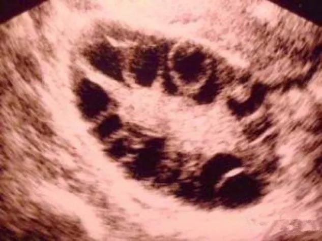 月经后错、多毛、长痘、肥胖,警惕多囊卵巢综合征