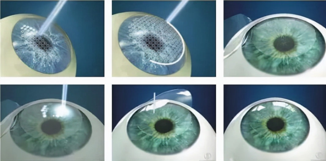 征兵近视可以先报名再手术矫正吗,近视报名当兵再做近视手术可以吗