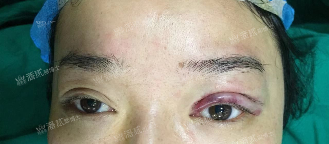 提肌矫正失败的表现眼皮睁不开,做完提肌眼睛前半段下垂